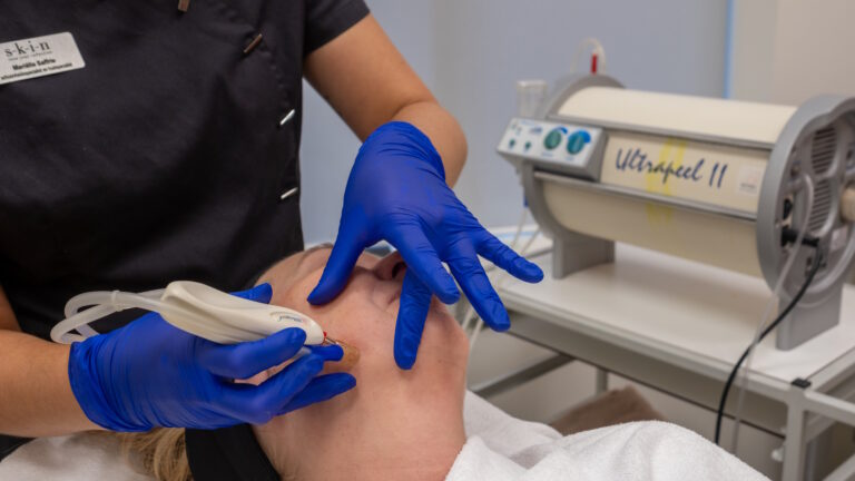 microdermabrasie behandeling