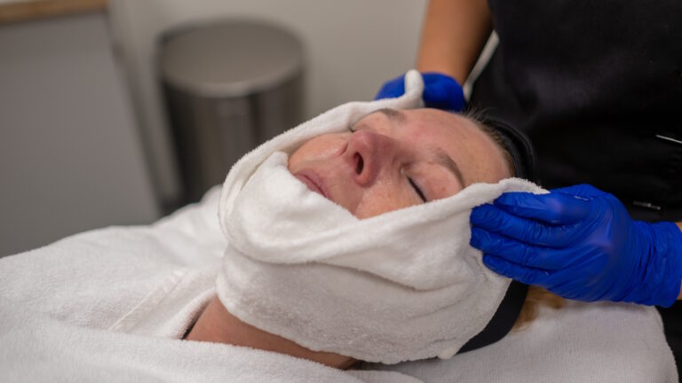 chemische peeling