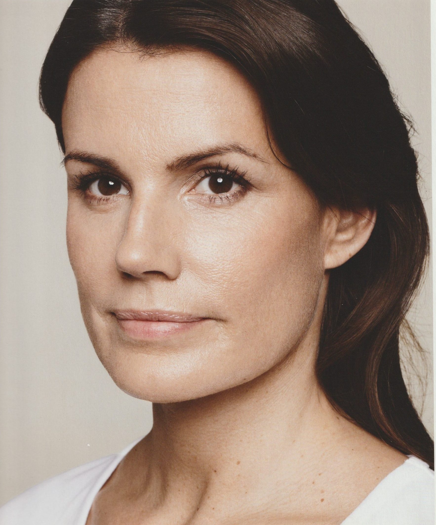 Botox behandeling after