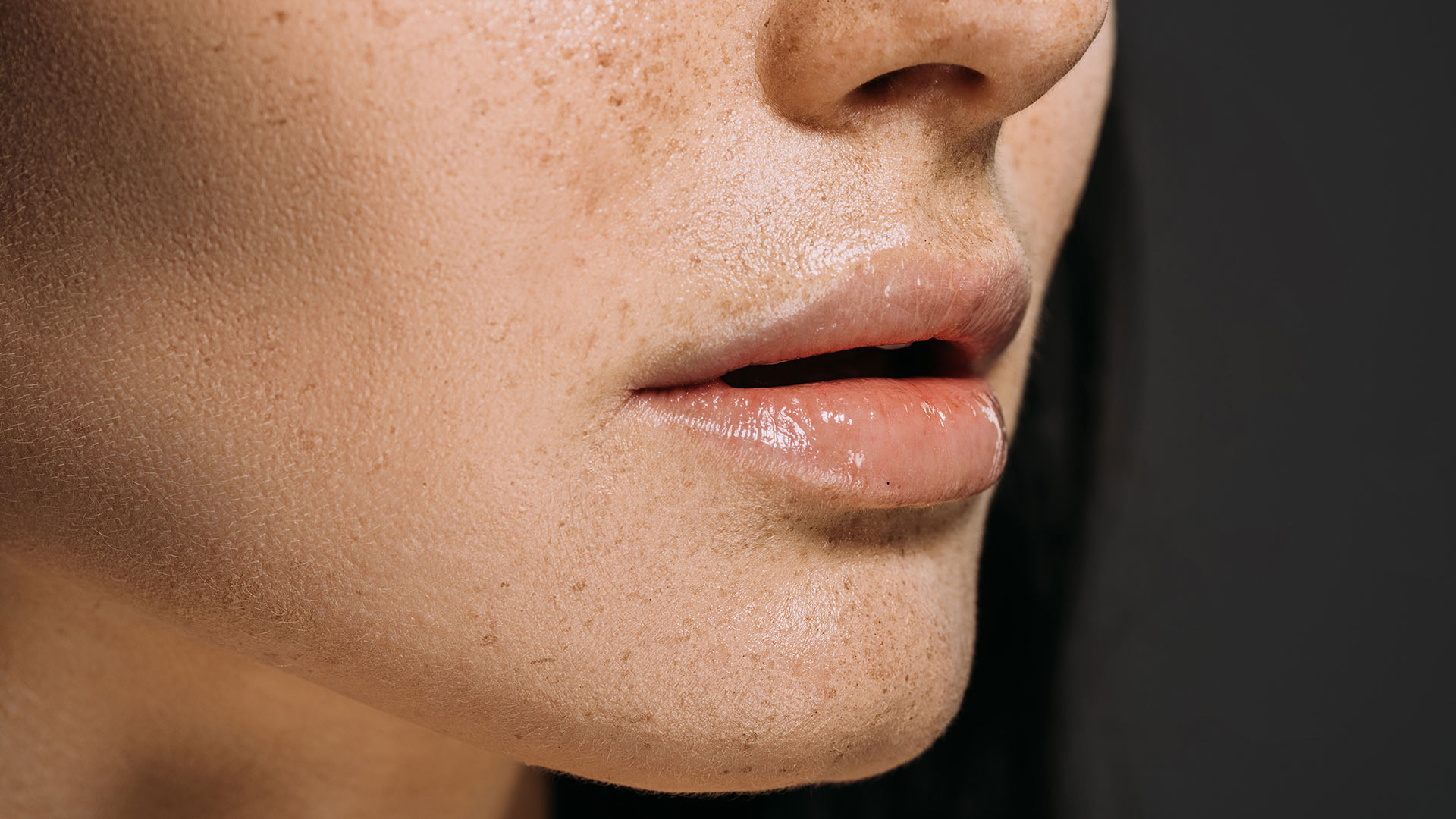 Botox lipflip